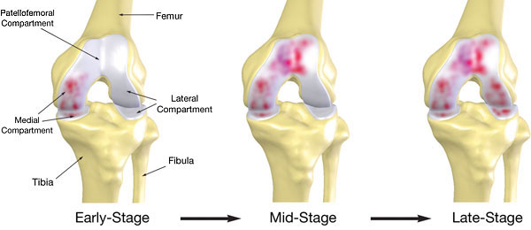  Knee Joint Pain 